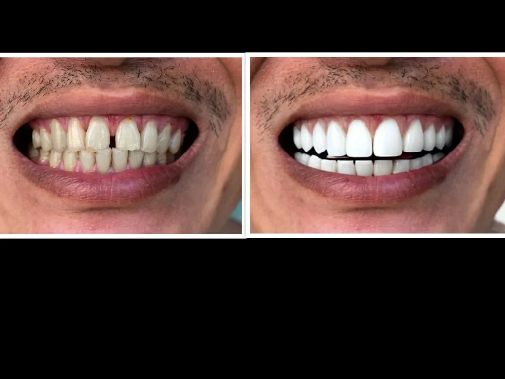 Teeth Comparasion