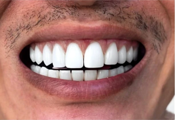 Teeth whiten result