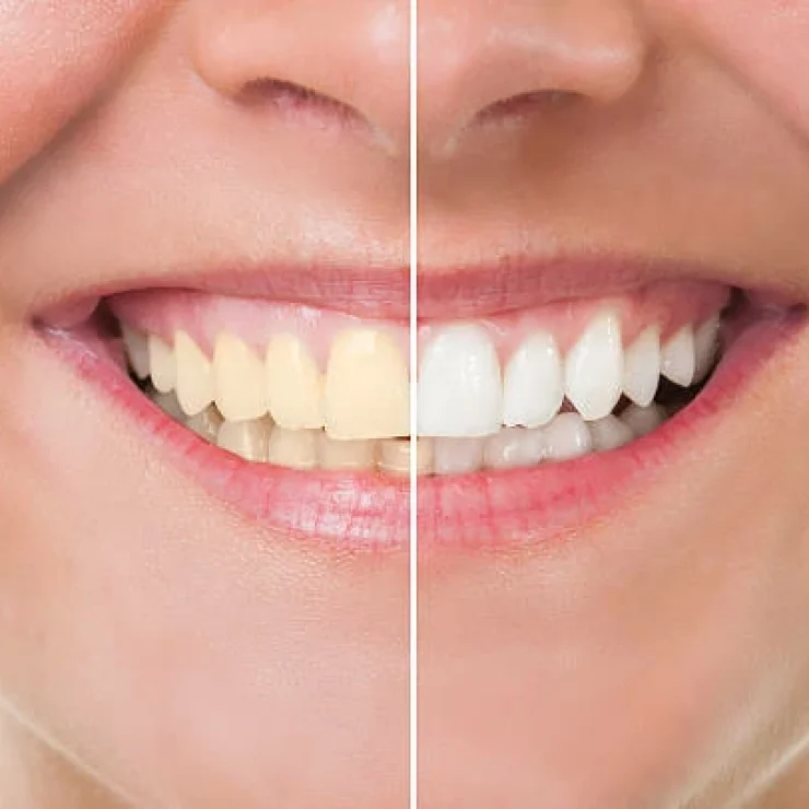 How Can I Edit a Picture to Whiten Teeth?