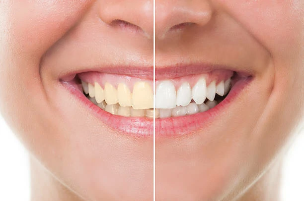 Whiten Teeth