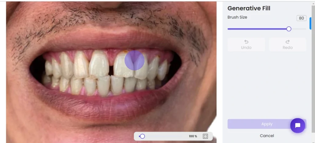 ZMO teeth whiten process 3