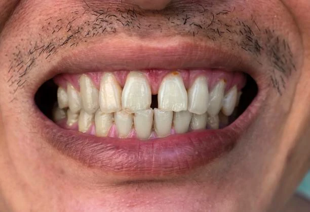 ZMO teeth whiten process